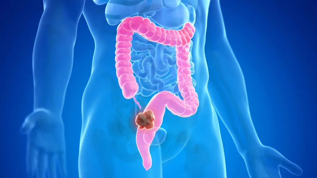 colorectal_cancer