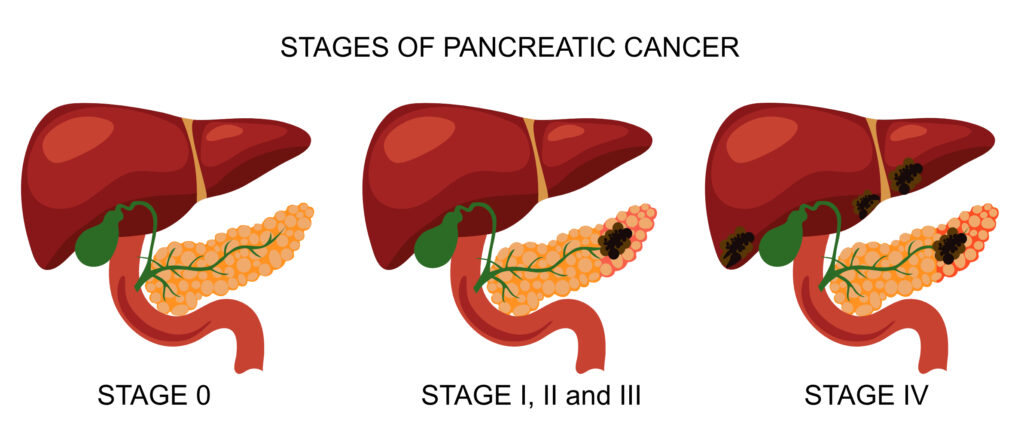 Stages-of-Pancreatic-Cancer