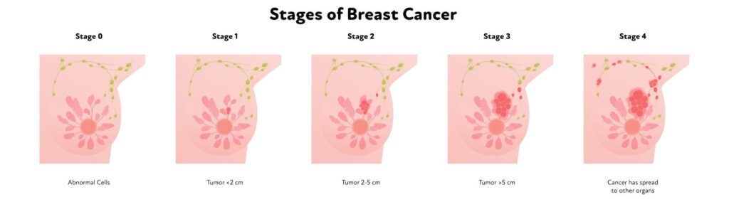 Breast cancer